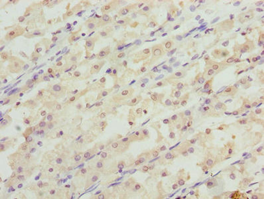 Immunohistochemistry of paraffin-embedded human gastric cancer using CSB-PA019567LA01HU at dilution of 1:100