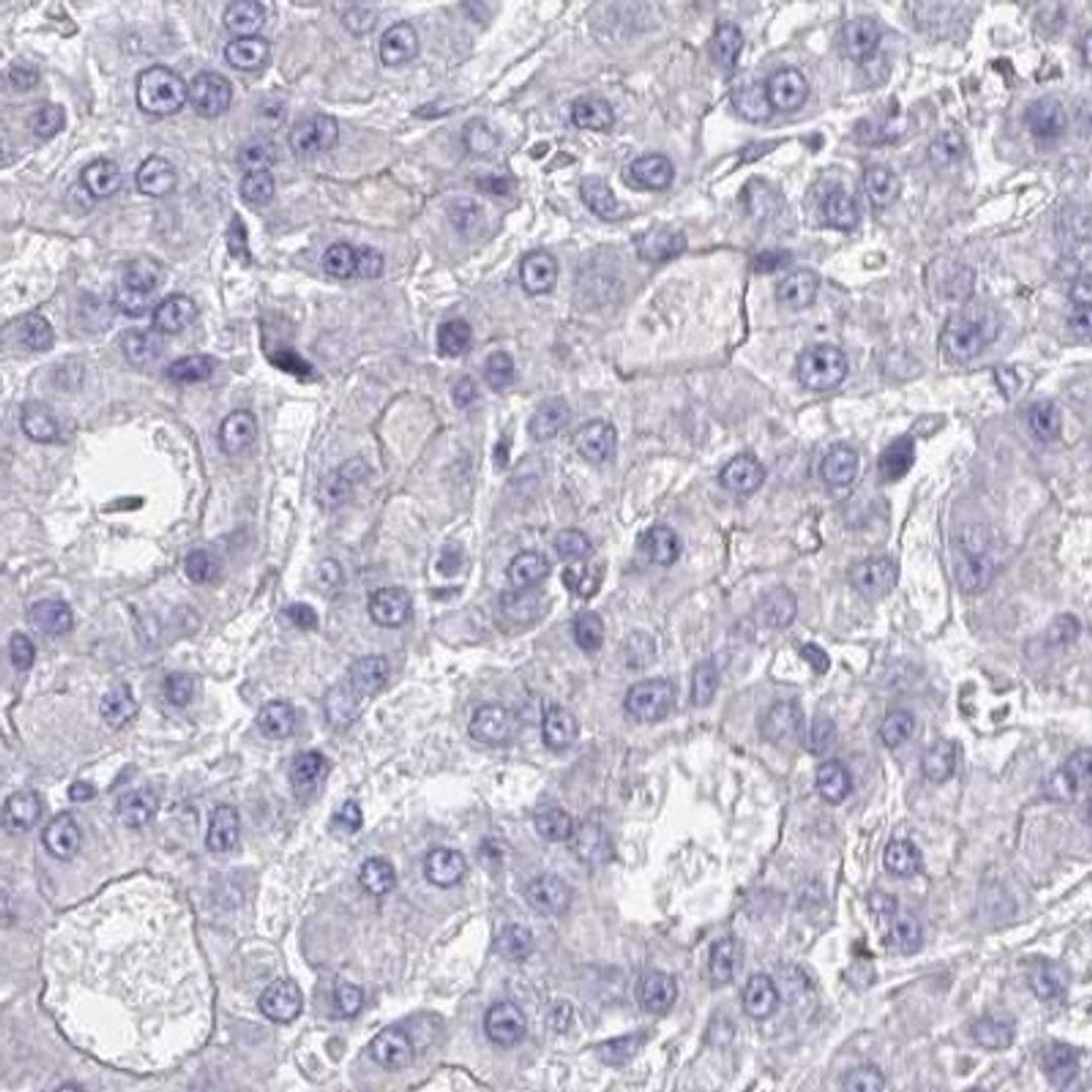 Immunohistochemistry: Carbohydrate sulfotransferase 3 Antibody [NBP2-31611] - liver cancer