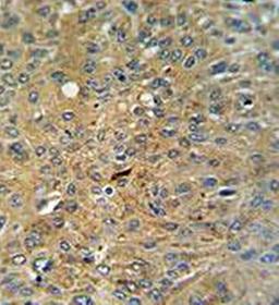 Immunohistrochemical analysis of formalin fixed and paraffin embedded human lung carcinoma tissue using Cleaved-CASP3 (Asp175) antibody 