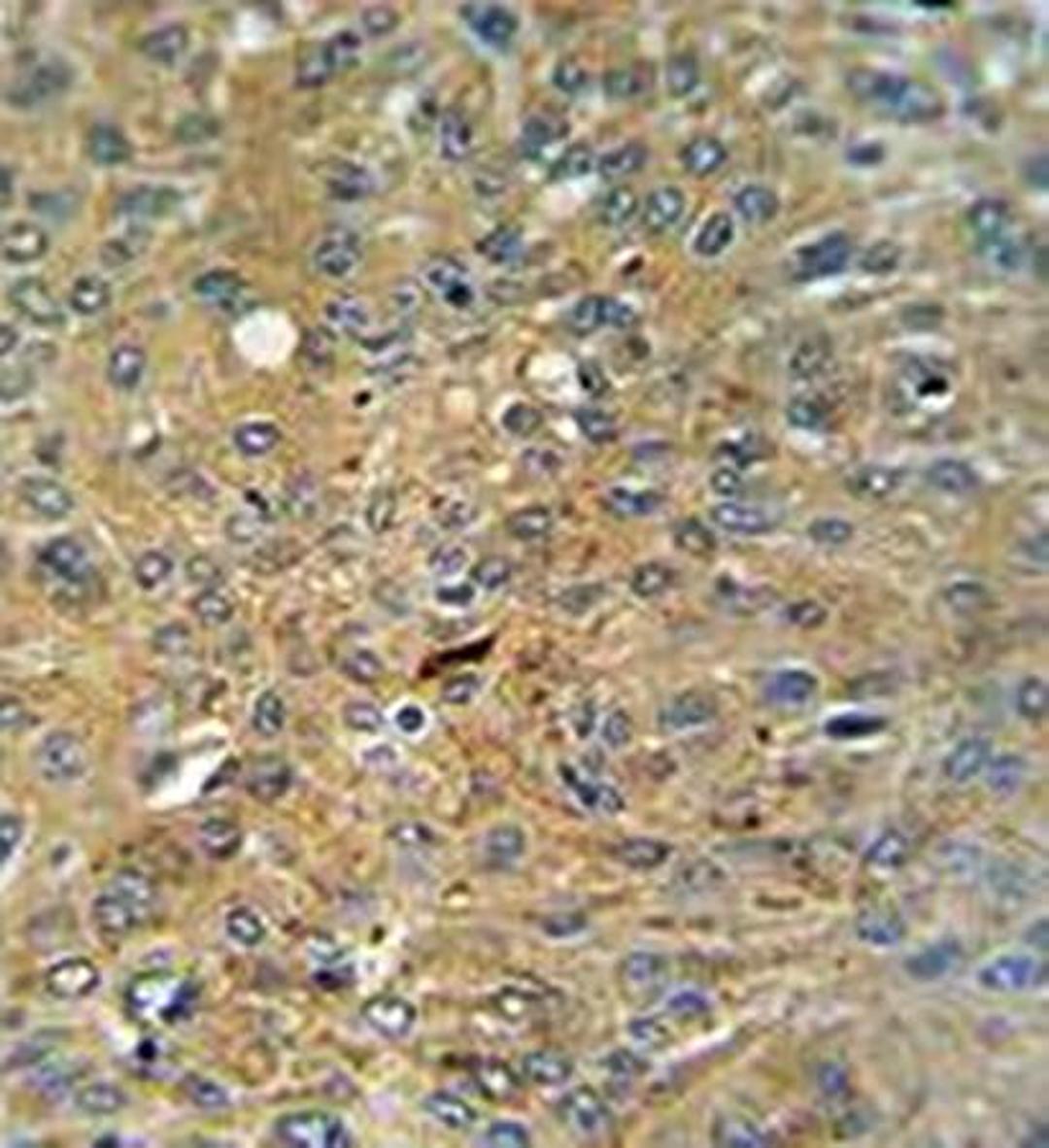 Immunohistrochemical analysis of formalin fixed and paraffin embedded human lung carcinoma tissue using Cleaved-CASP3 (Asp175) antibody