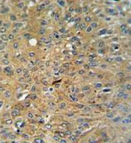 Immunohistrochemical analysis of formalin fixed and paraffin embedded human lung carcinoma tissue using Cleaved-CASP3 (Asp175) antibody