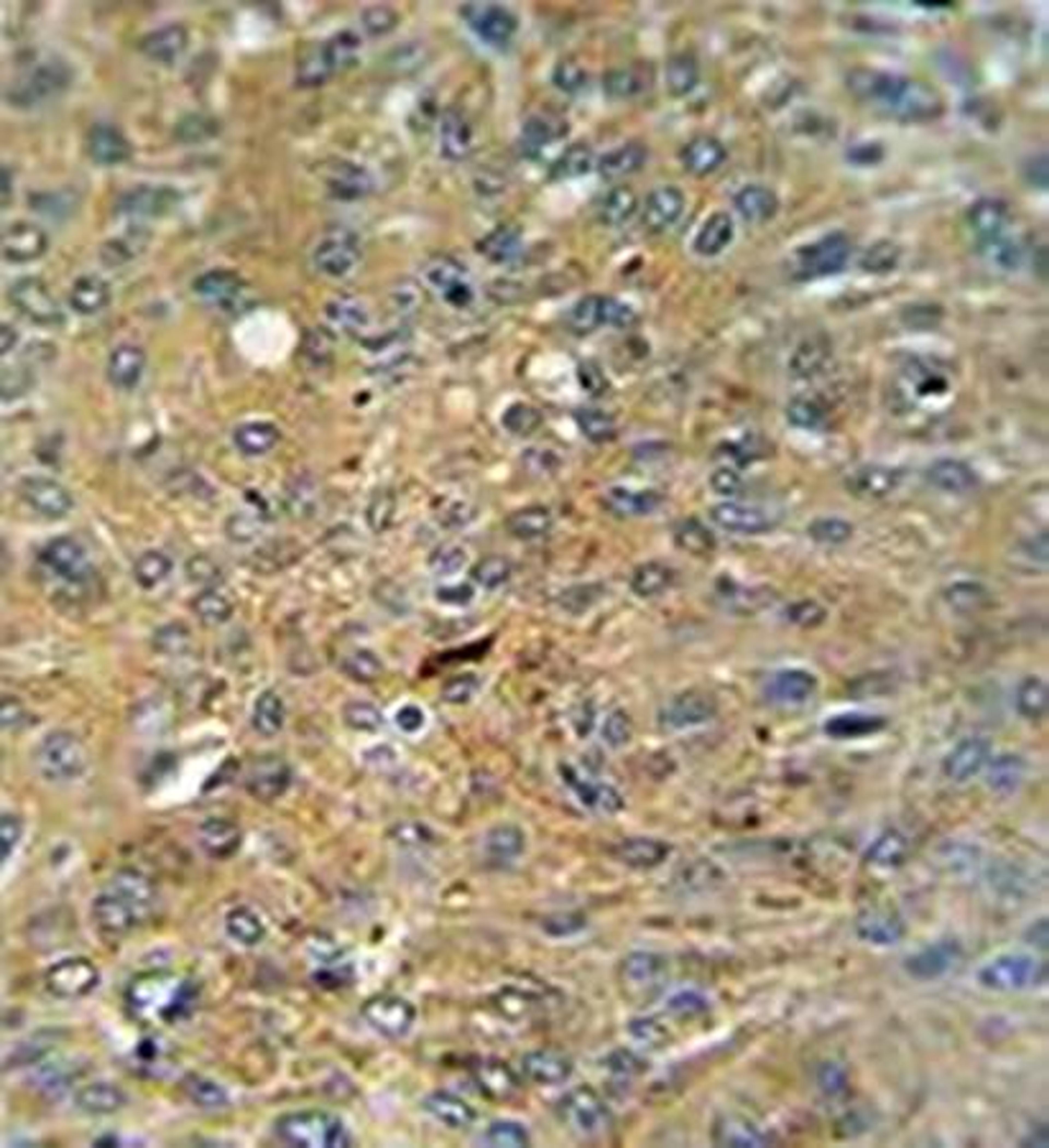 Immunohistrochemical analysis of formalin fixed and paraffin embedded human lung carcinoma tissue using Cleaved-CASP3 (Asp175) antibody