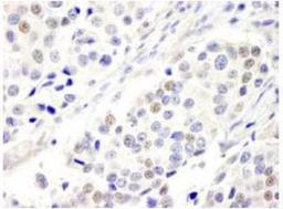 Immunohistochemistry-Paraffin: ABC2 Antibody [NB100-74598] - FFPE section of human breast carcinoma. Antibody: Affinity purified rabbit anti-ABC2 used at  a dilution of 1:250. Detection: DAB staining using  Immunohistochemistry Accessory Kit