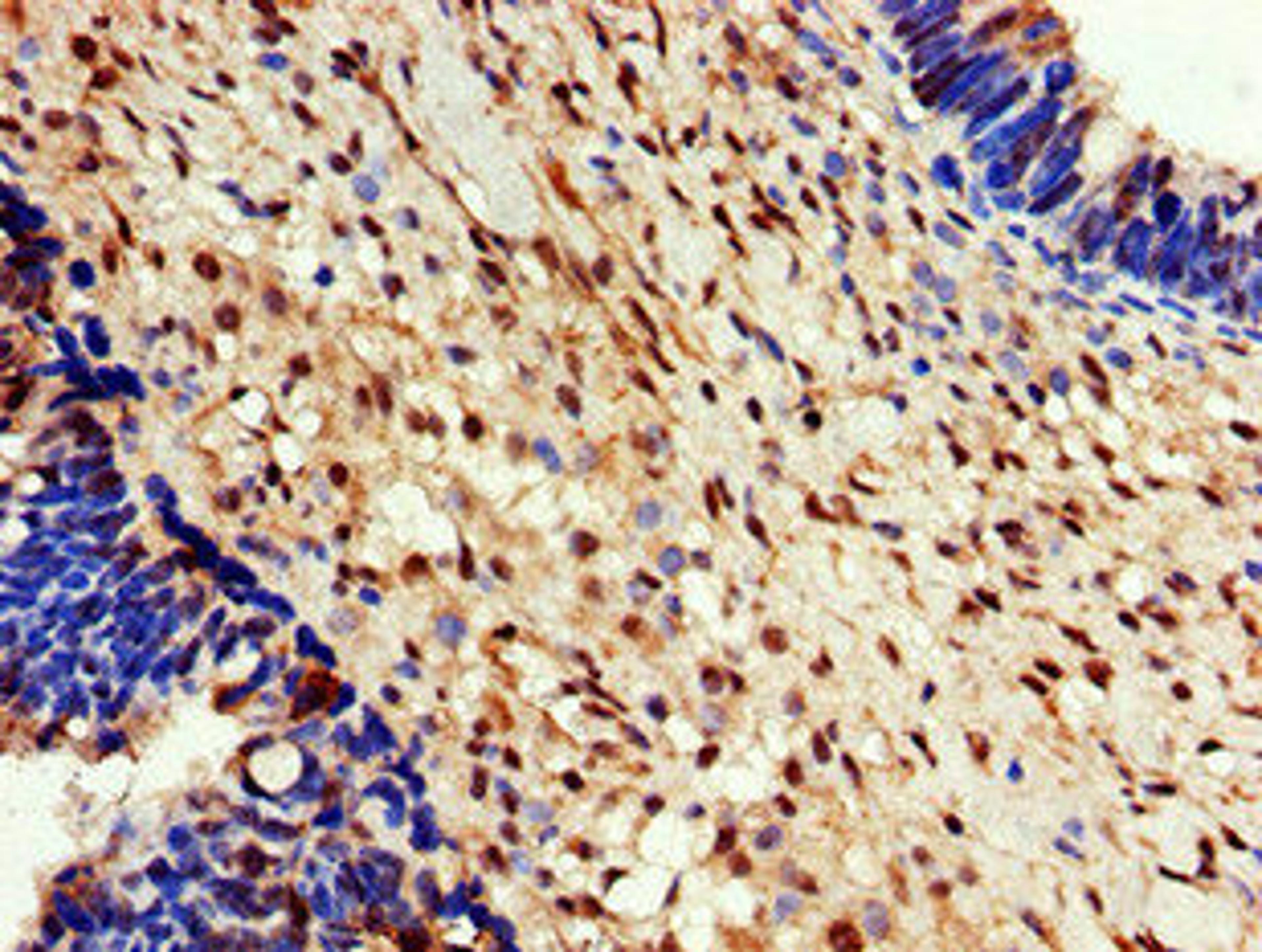Immunohistochemistry of paraffin-embedded human ovarian cancer using CSB-PA007435LA01HU at dilution of 1:100