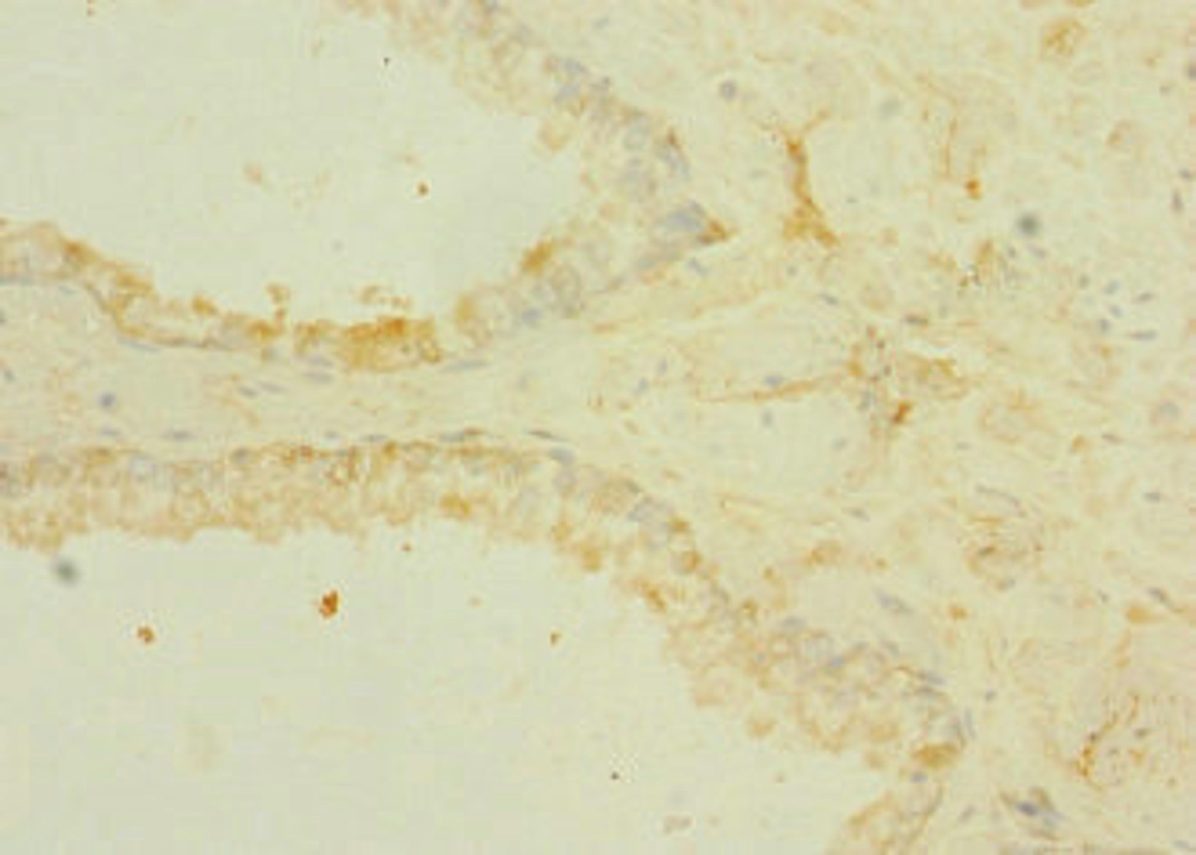 Immunohistochemistry of paraffin-embedded human prostate cancer using CSB-PA863139ESR1HU at dilution of 1:100