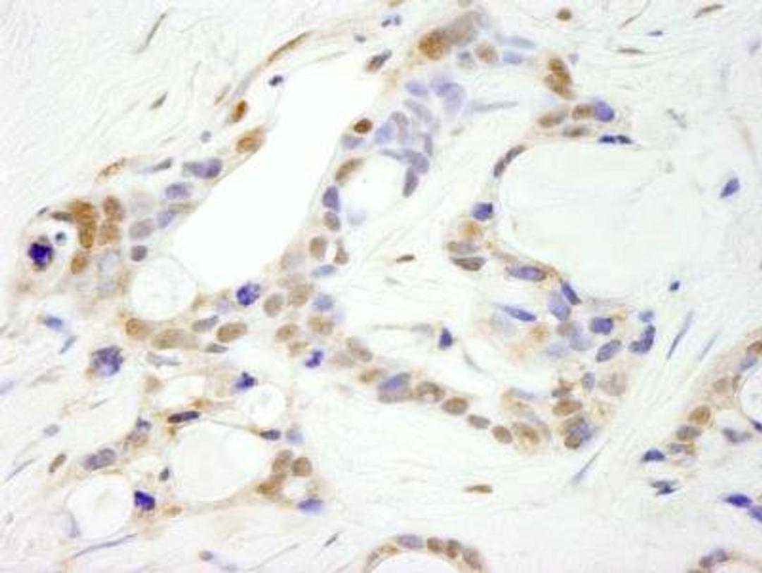 Immunohistochemistry: CPSF2 Antibody [NB100-79823] - FFPE section of human ovarian carcinoma. Antibody used at a dilution of 1:250.  Detection: DAB staining using Immunohistochemistry Accessory Kit.