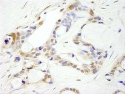 Immunohistochemistry: CPSF2 Antibody [NB100-79823] - FFPE section of human ovarian carcinoma. Antibody used at a dilution of 1:250.  Detection: DAB staining using Immunohistochemistry Accessory Kit.