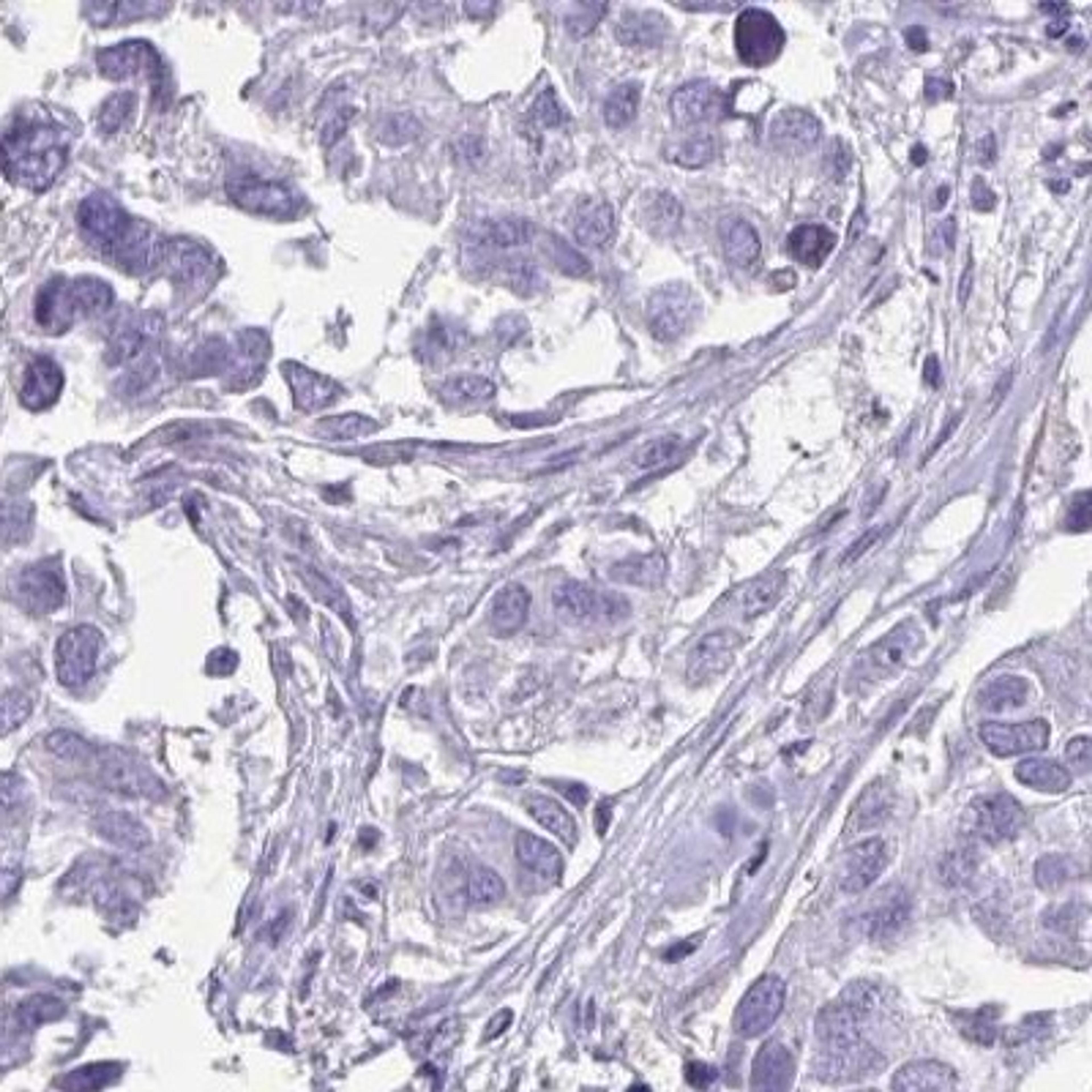 Immunohistochemistry: OR51B5 Antibody [NBP2-32376] - breast cancer