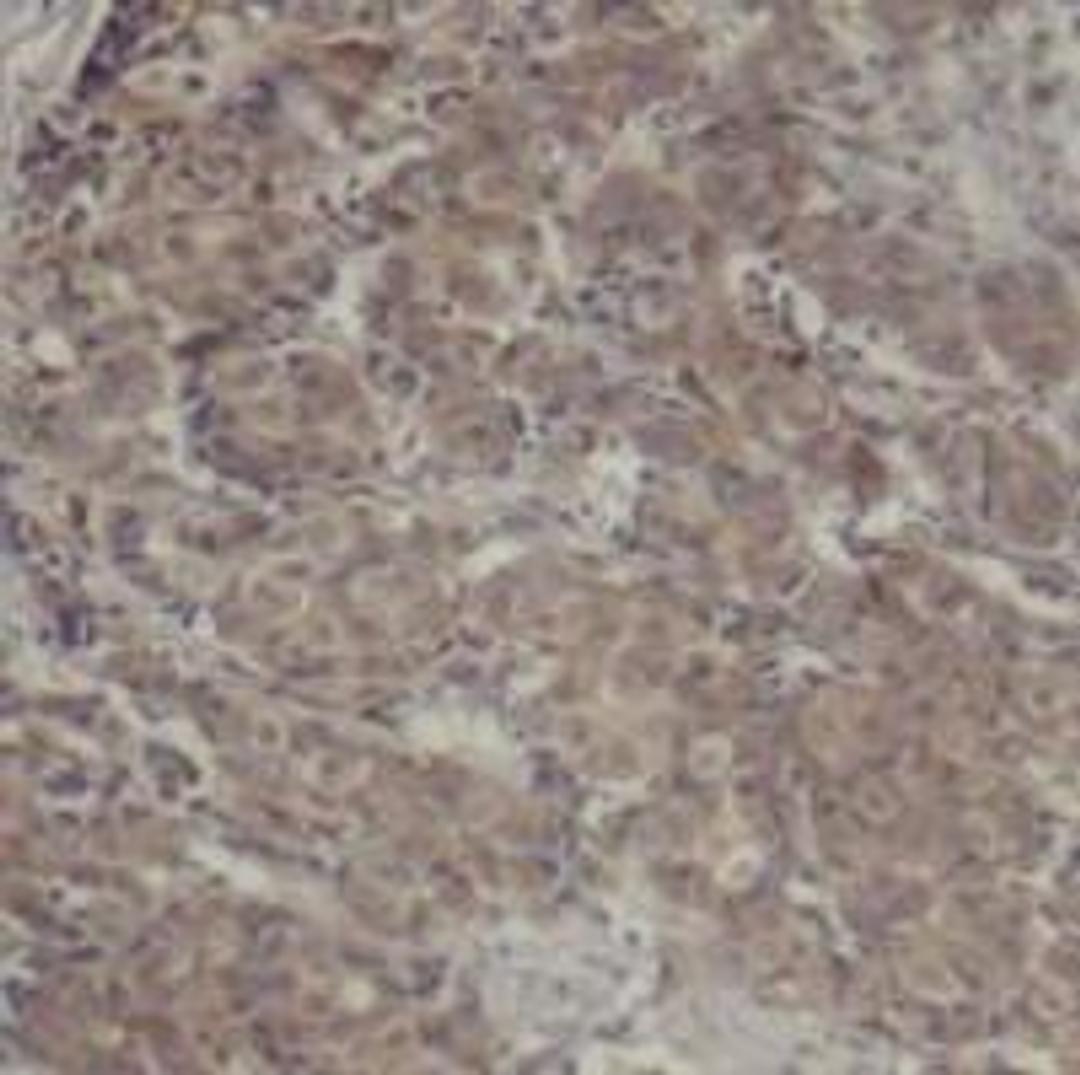 Immunohistochemical analysis of paraffin-embedded human breast carcinoma tissue using CREB (Ab-142).