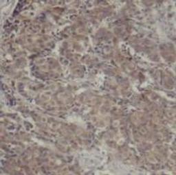 Immunohistochemical analysis of paraffin-embedded human breast carcinoma tissue using CREB (Ab-142).