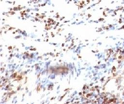 Formalin-fixed, paraffin-embedded human colon carcinoma stained with p27Kip1 antibody (KIP1/769)