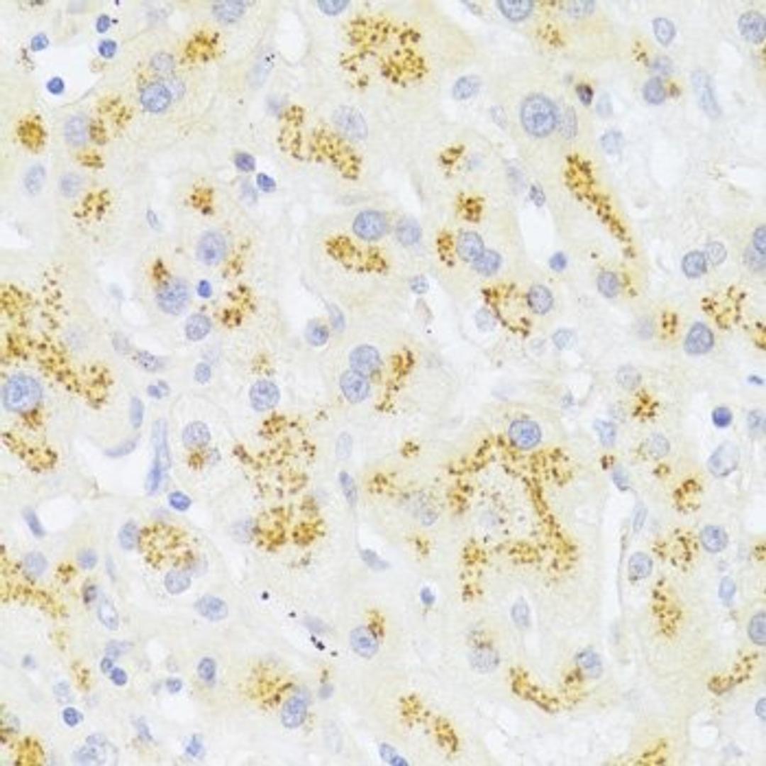 Immunohistochemistry of paraffin-embedded human liver cancer using FAS antibody