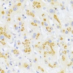 Immunohistochemistry of paraffin-embedded human liver cancer using FAS antibody