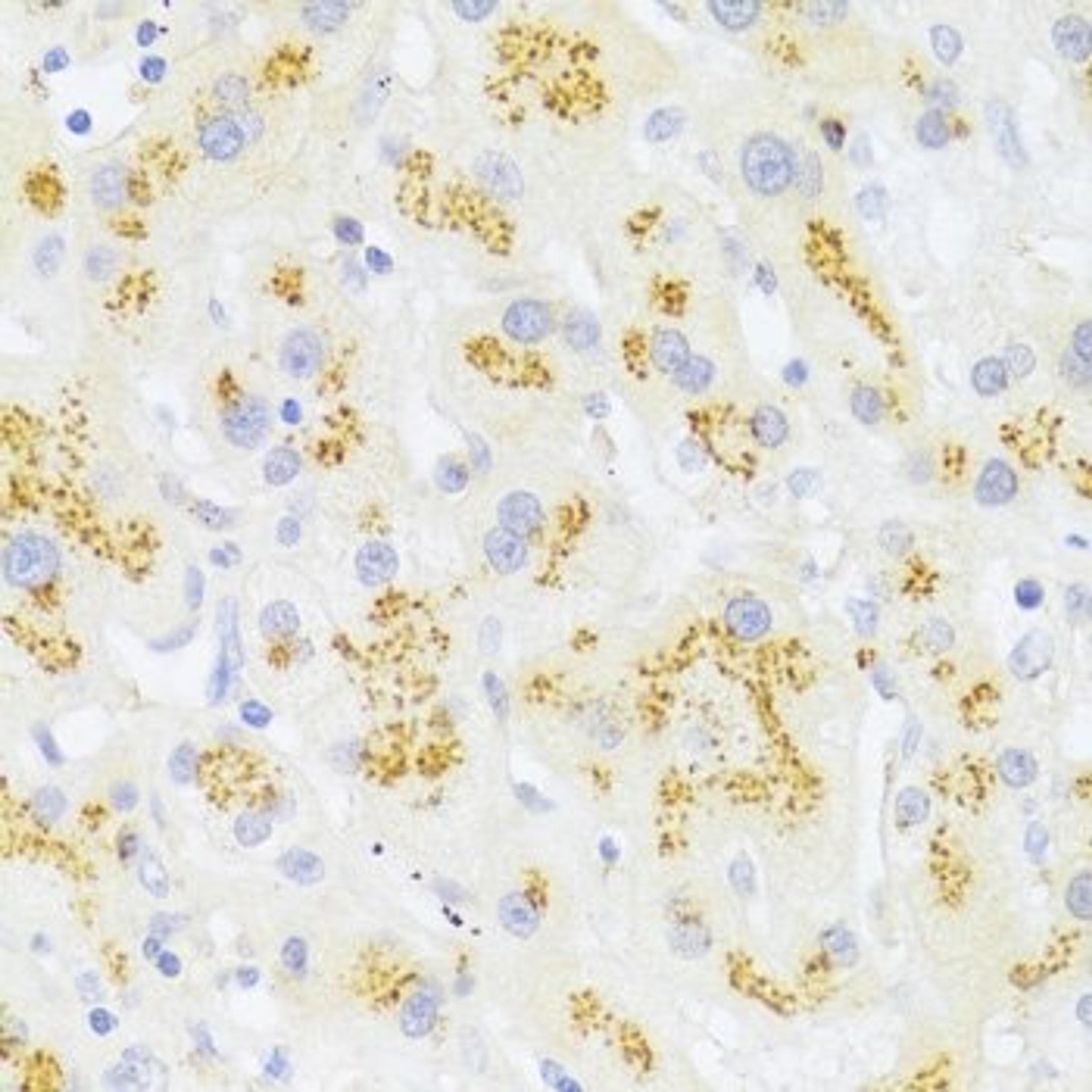 Immunohistochemistry of paraffin-embedded human liver cancer using FAS antibody