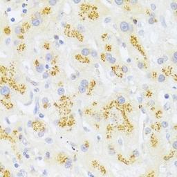 Immunohistochemistry of paraffin-embedded human liver cancer using FAS antibody