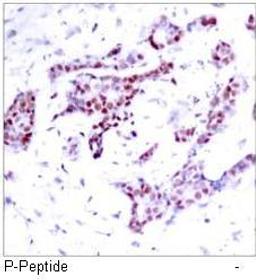 Immunohistochemical analysis of paraffin-embedded human breast carcinoma tissue using STAT1 (phospho-Tyr701) antibody