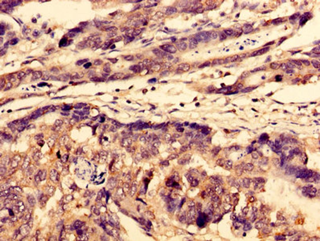 Immunohistochemistry of paraffin-embedded human gastric cancer using CSB-PA809030LA01HU at dilution of 1:100