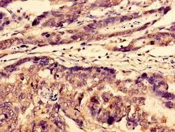 Immunohistochemistry of paraffin-embedded human gastric cancer using CSB-PA809030LA01HU at dilution of 1:100
