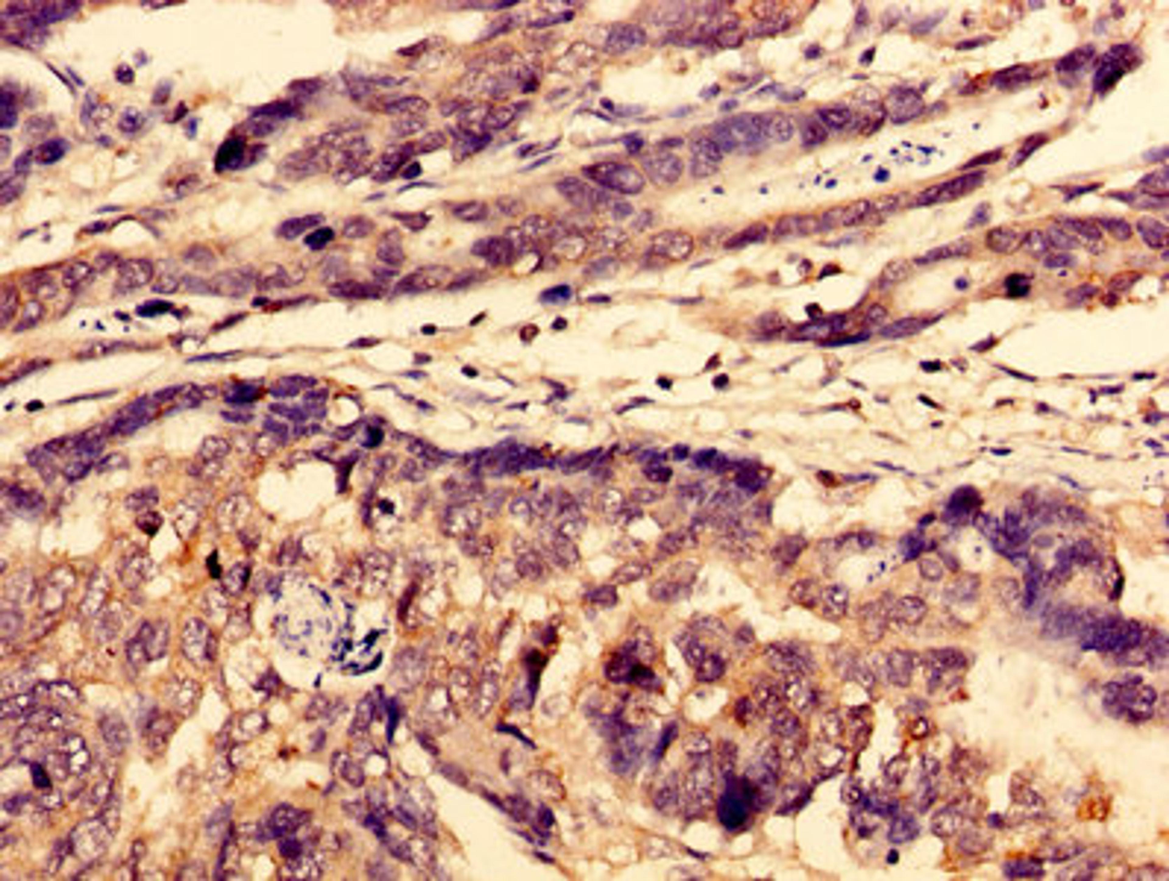 Immunohistochemistry of paraffin-embedded human gastric cancer using CSB-PA809030LA01HU at dilution of 1:100