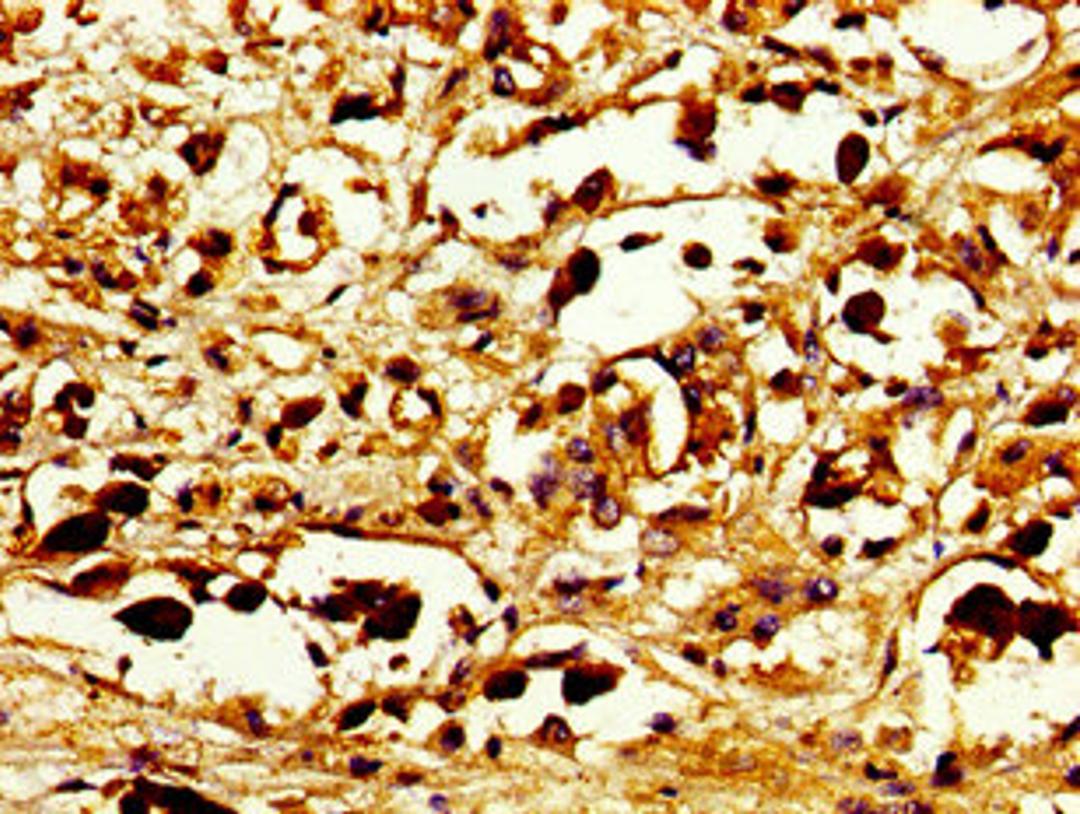 Immunohistochemistry of paraffin-embedded human melanoma using CSB-PA892321LA01HU at dilution of 1: 100