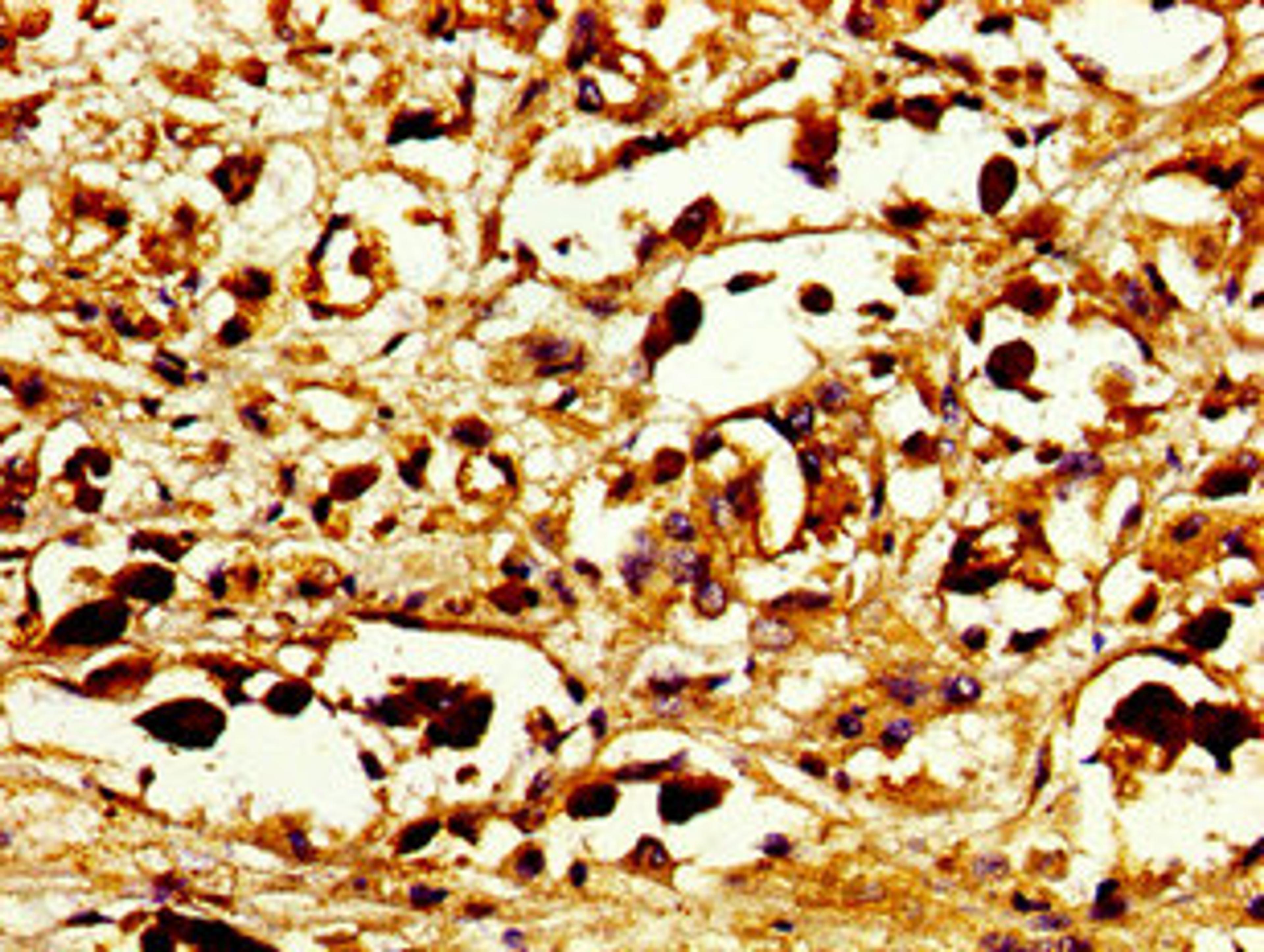 Immunohistochemistry of paraffin-embedded human melanoma using CSB-PA892321LA01HU at dilution of 1: 100