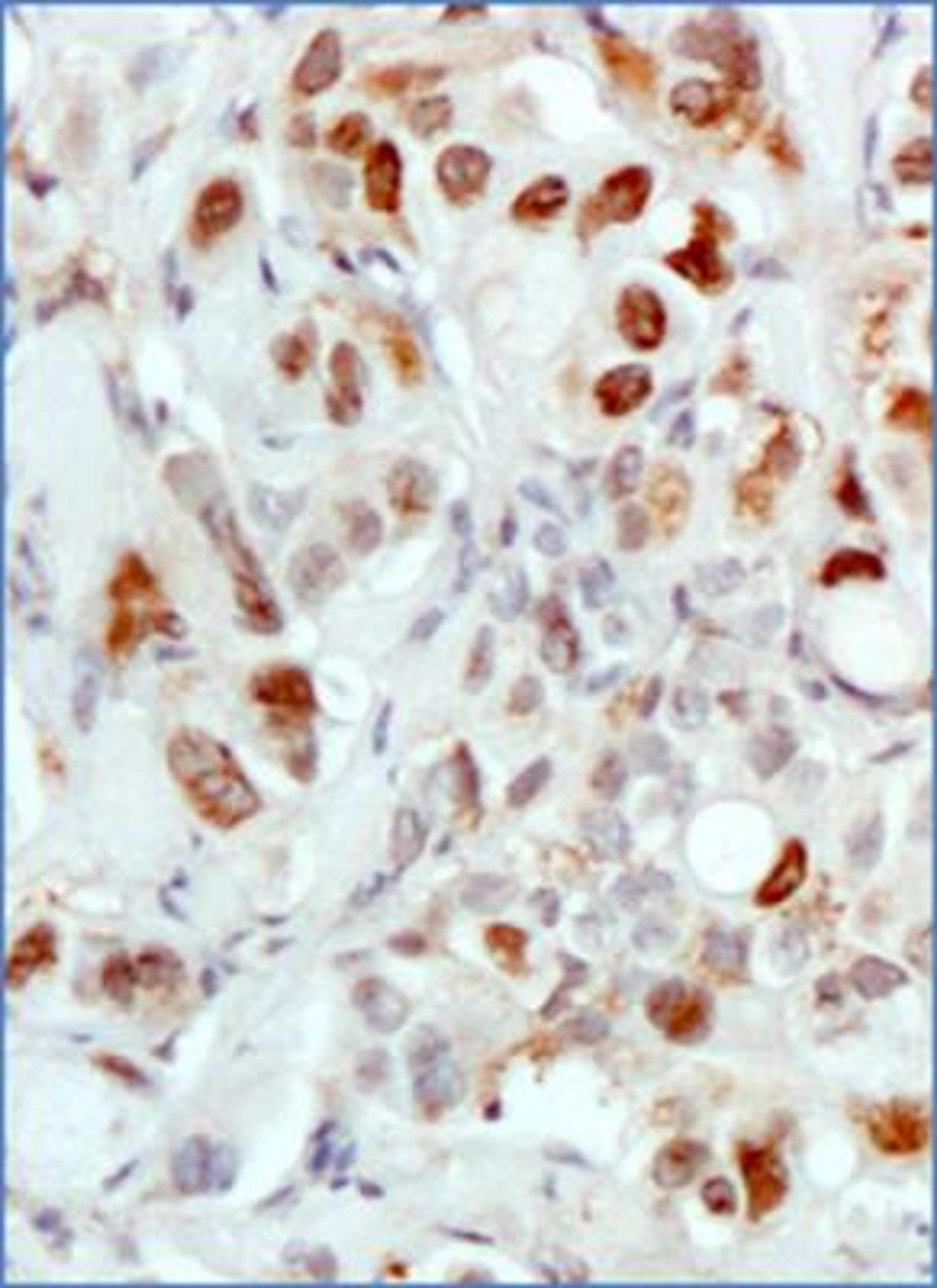 Immunohistochemistry-Paraffin: MDM2/HDM2 Antibody (SMP14) [NB100-2736] - IHC analysis of formalin fixed paraffin embedded tissue section of human breast cancer xenograft using MDM2/HDM2 antibody (clone SMP14) at 1:100 dilution. Several of the cancer cells developed a strong nuclear with weak cytoplasmic immunostaining of MDM2.