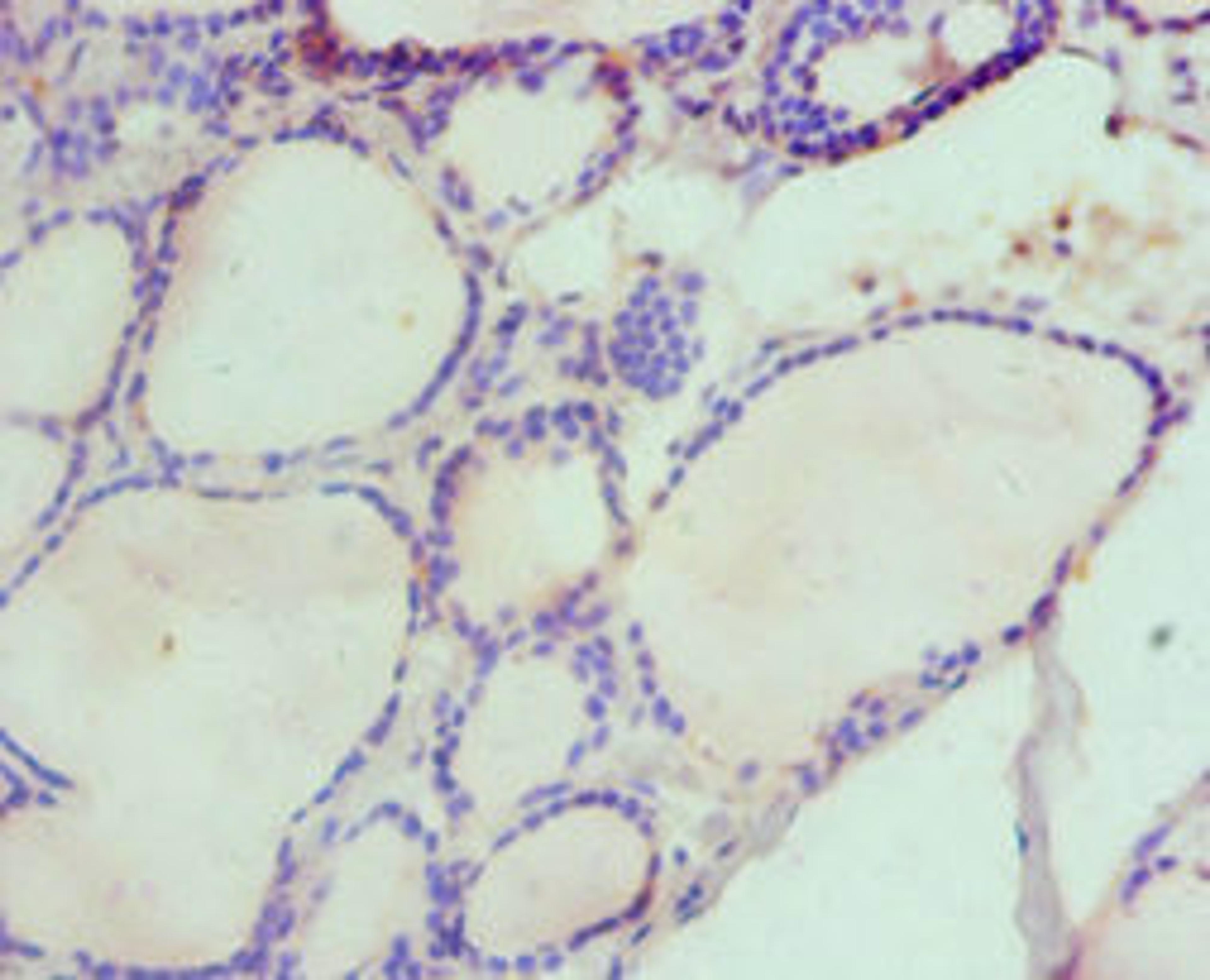 Immunohistochemistry of paraffin-embedded human thyroid tissue using CSB-PA010142ESR1HU at dilution of 1:100