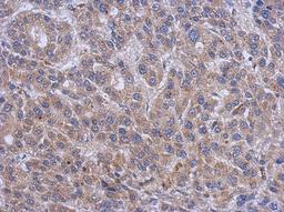 Immunohistochemistry-Paraffin: Serine Palmitoyltransferase 2 Antibody [NBP2-20308] - Immunohistochemical analysis of paraffin-embedded Hepatoma, using antibody at 1:500 dilution.