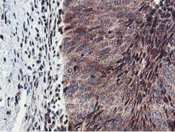 Immunohistochemistry-Paraffin: HEXO Antibody (1B3) [NBP2-01655] - Staining of paraffin-embedded Carcinoma of Human bladder tissue using anti-HEXO mouse monoclonal antibody.