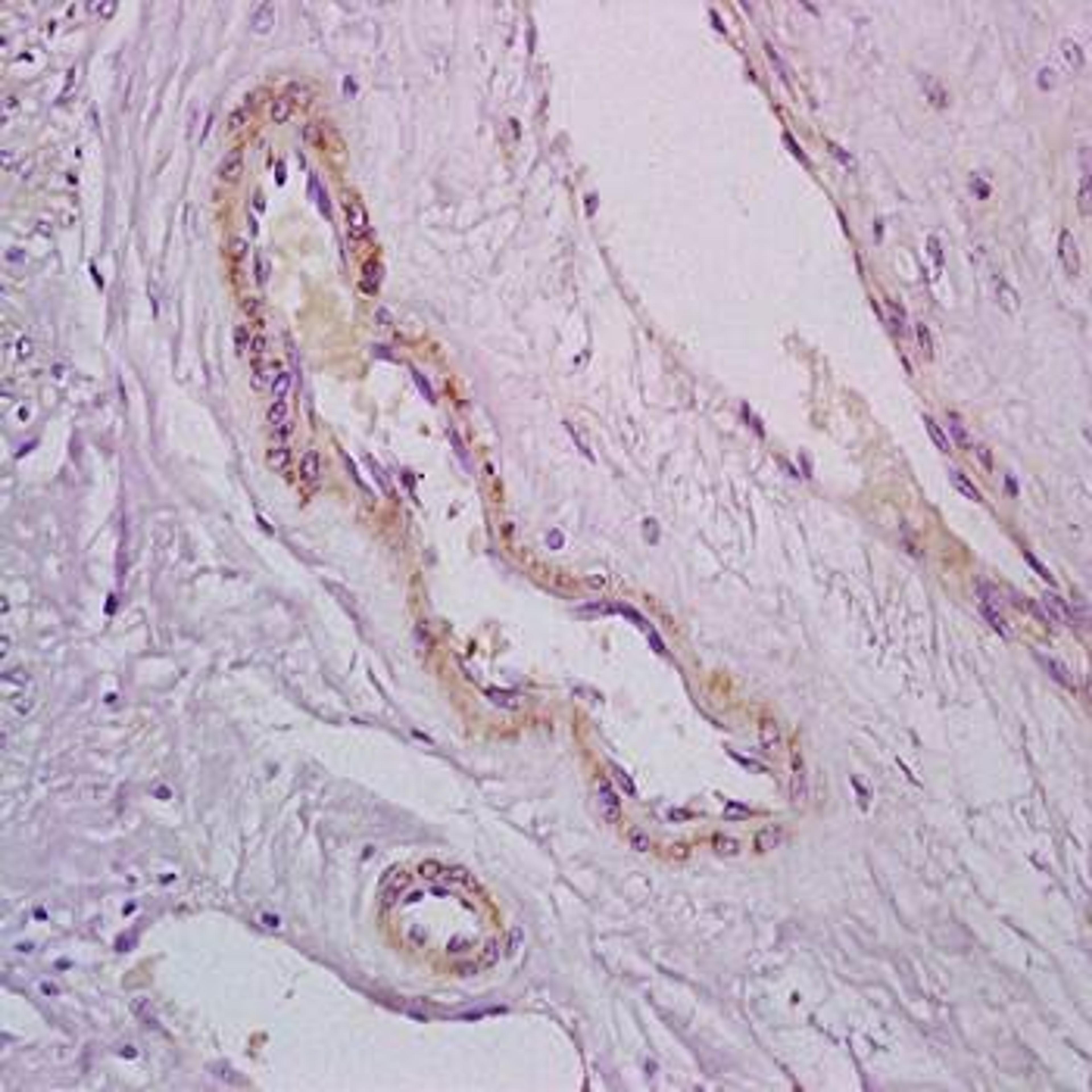 Immunohistochemical analysis of formalin-fixed and paraffin embedded human cervical carcinoma tissue (dilution at:1:200) using PDE5A antibody