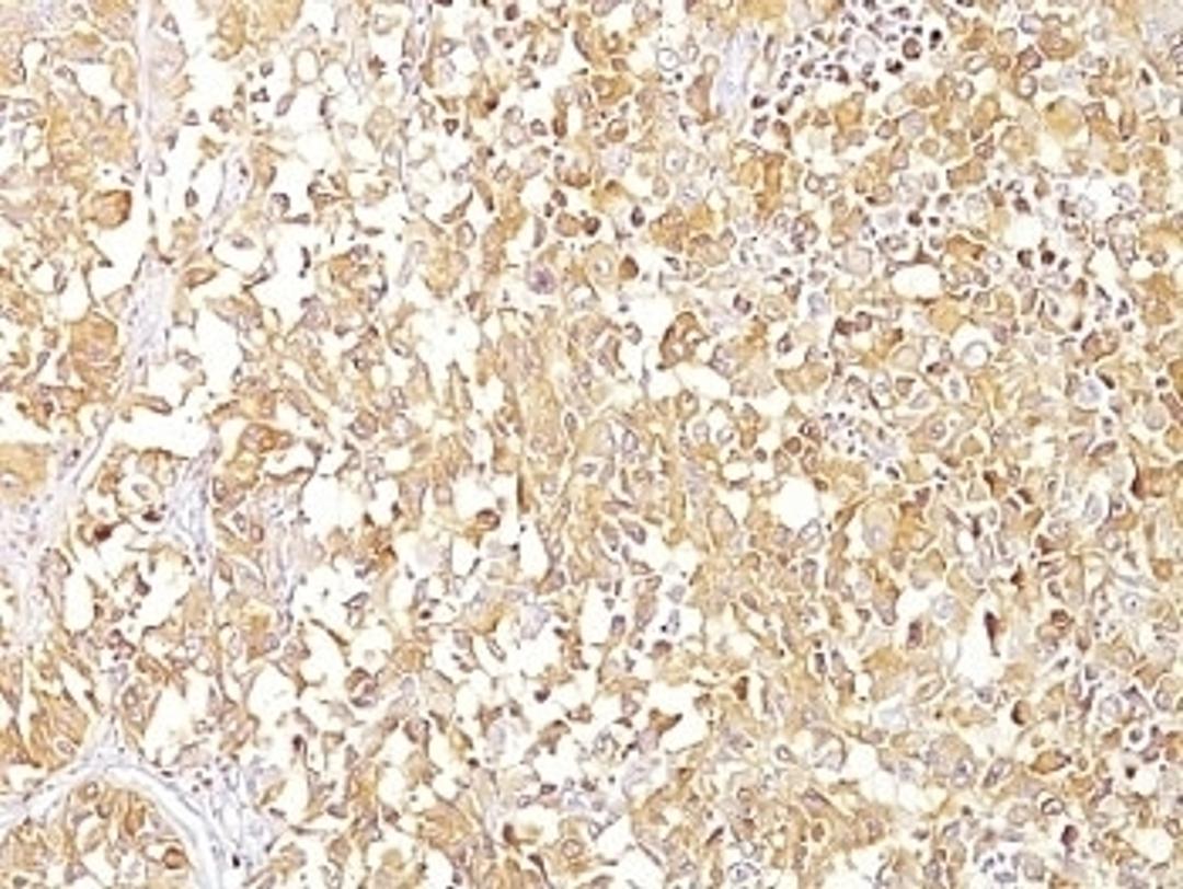 Formalin-fixed, paraffin-embedded human melanoma stained with gp100 antibody (SPM142).