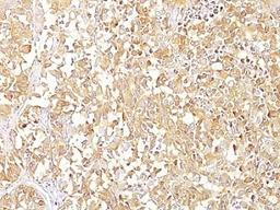 Formalin-fixed, paraffin-embedded human melanoma stained with gp100 antibody (SPM142).