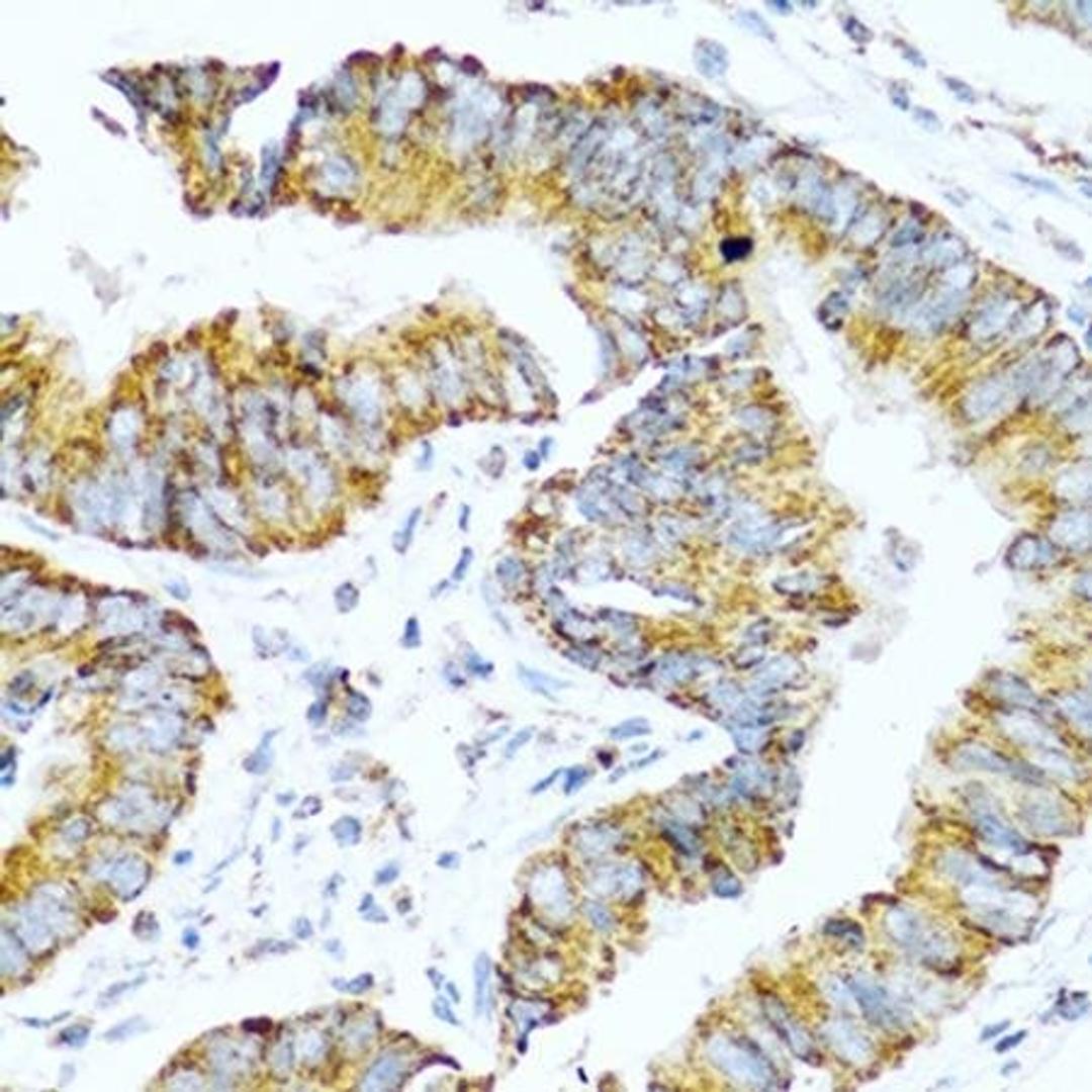 Immunohistochemical staining of human colon carcinoma tissue using GCG antibody