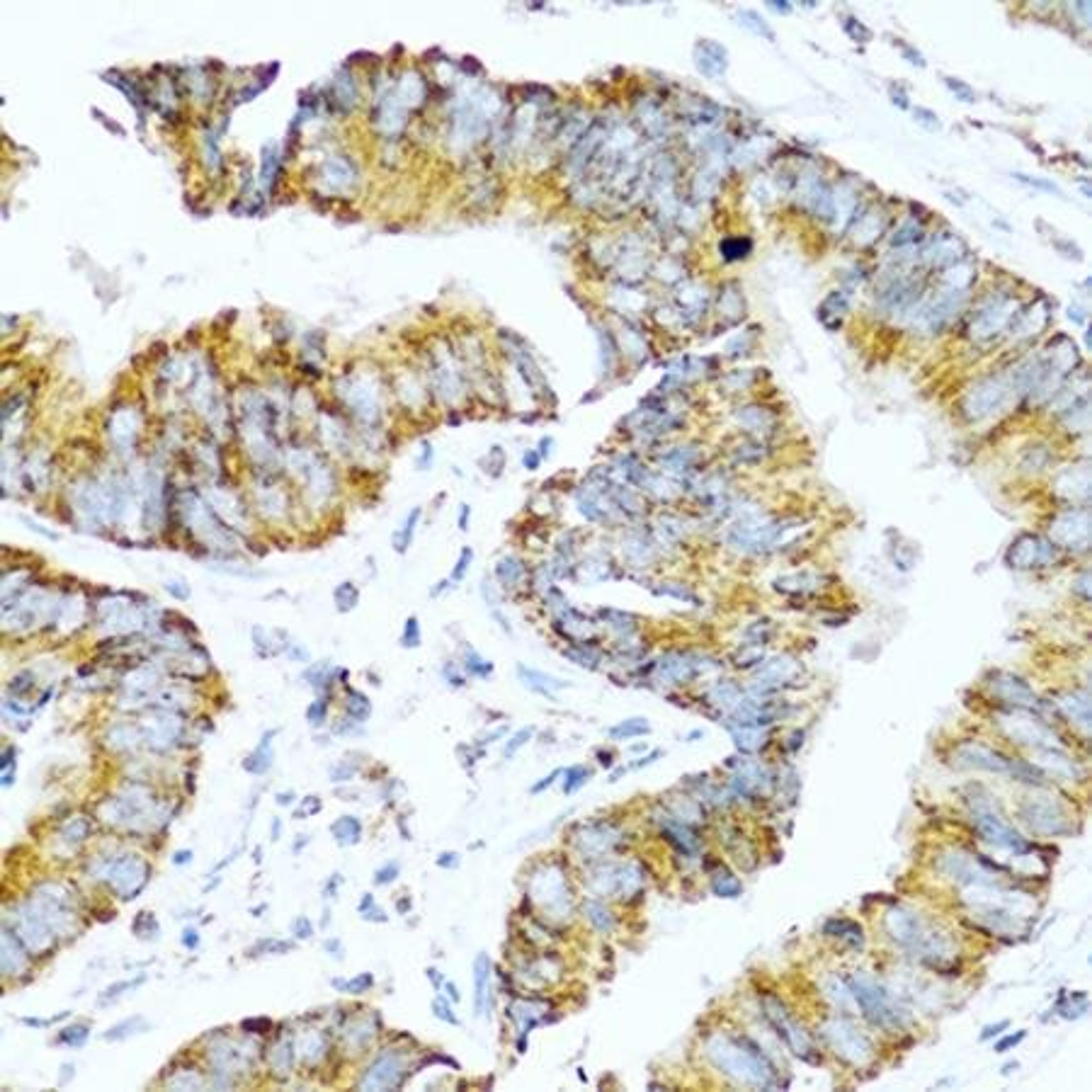 Immunohistochemical staining of human colon carcinoma tissue using GCG antibody