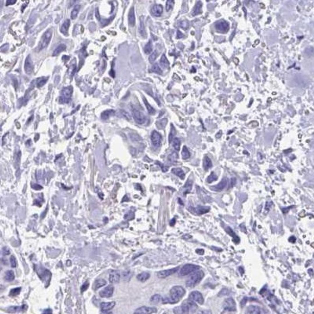 Immunohistochemistry: USP35 Antibody [NBP2-32393] - breast cancer