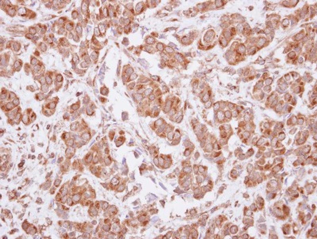 Immunohistochemistry-Paraffin: MAGEA4 Antibody [NBP2-17204] - Immunohistochemical analysis of paraffin-embedded Breast ca, using antibody at 1:500 dilution.