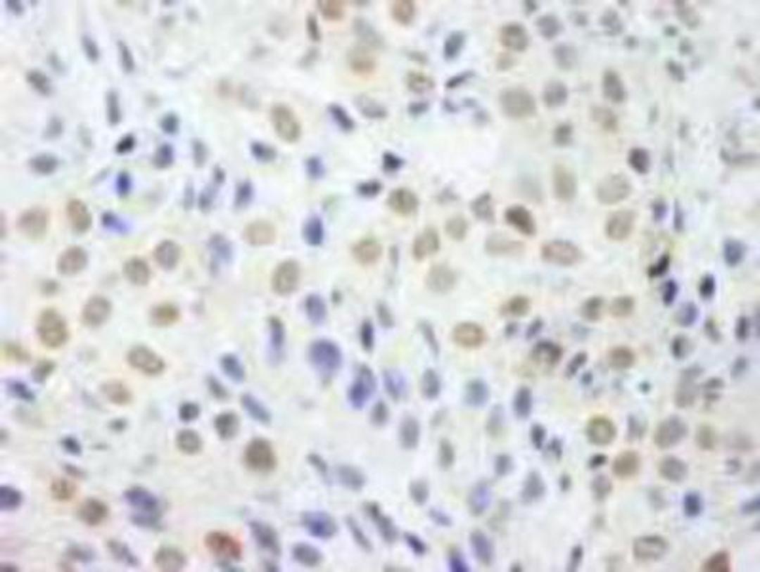 Immunohistochemistry-Paraffin: DDX54 Antibody [NB100-60677] - FFPE section of human breast carcinoma.  Affinity purified rabbit anti-DDX54 used at a dilution of 1:250.