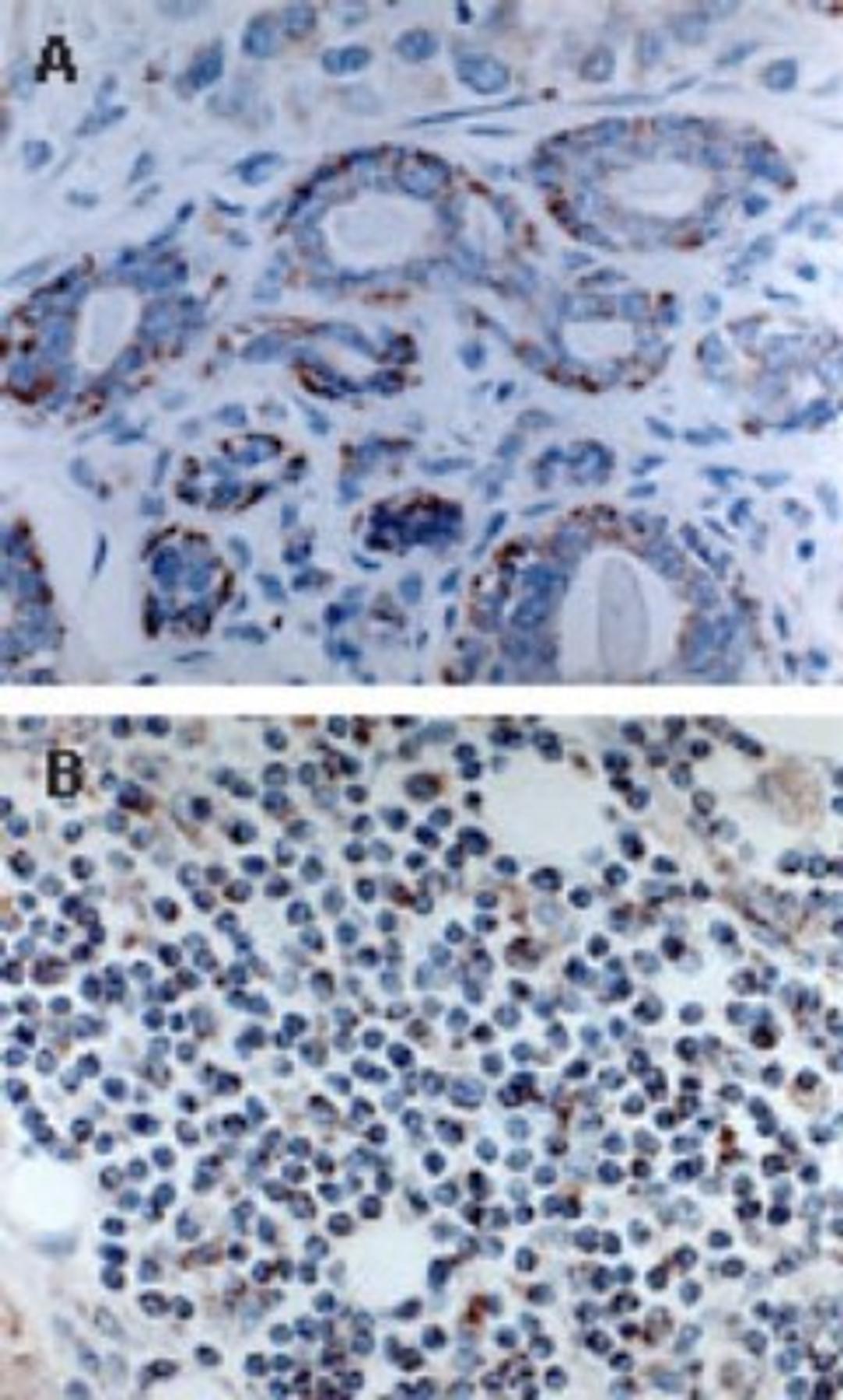 Immunohistochemistry-Paraffin: Bak Antibody [NB100-56092] - Formalin-fixed paraffin-embedded human tissue for Bak expression using this antibody at 1:2000. A. Ductal breast carcinoma. B. Lymphocyte infiltration in soft tissue adjacent to colon carcinoma. Hematoxylin-eosin counterstain.