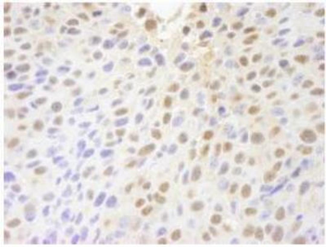 Immunohistochemistry-Paraffin: PARP10 Antibody [NB100-2157] - Section of mouse squamous cell carcinoma.