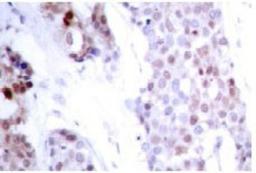 Immunohistochemistry: ATF4 [phospho Ser245] Antibody [NB100-92479] - Immunohistochemistry (IHC) analysis of p-ATF4  (S245) antibody in paraffin-embedded human breast  carcinoma tissue.