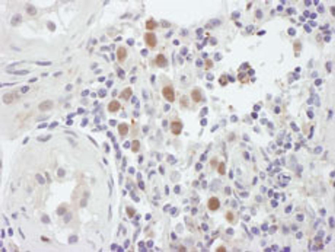 Detection of human MSH6 by immunohistochemistry.