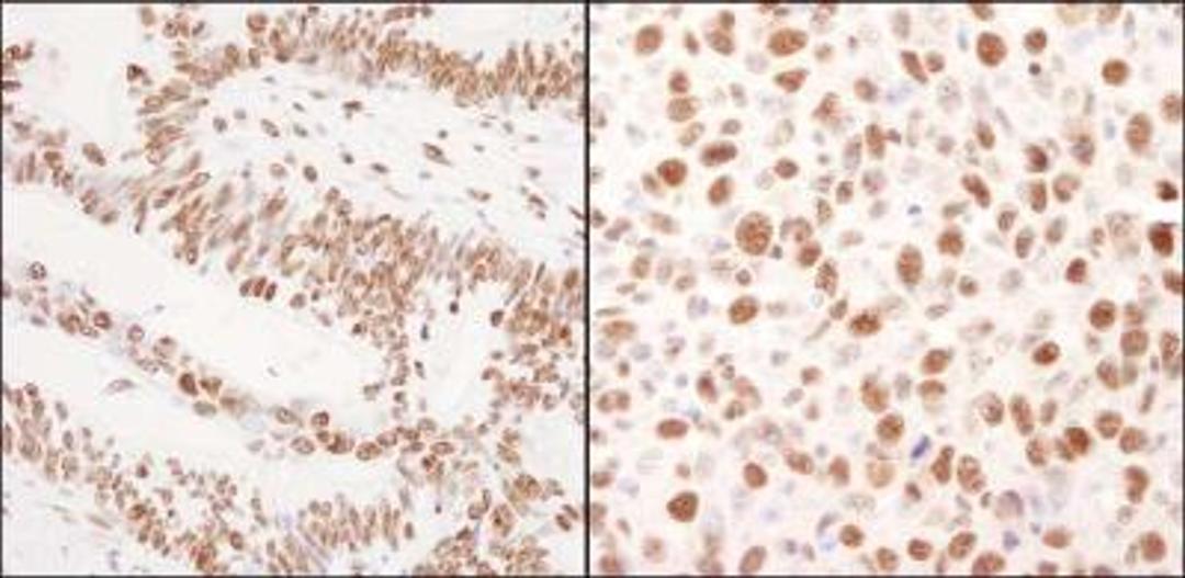 Immunohistochemistry-Paraffin: FUS Antibody [NB100-565] - Human colon carcinoma (left) and mouse squamous cell carcinoma (right).  Antibody used at a dilution of 1:1,000.