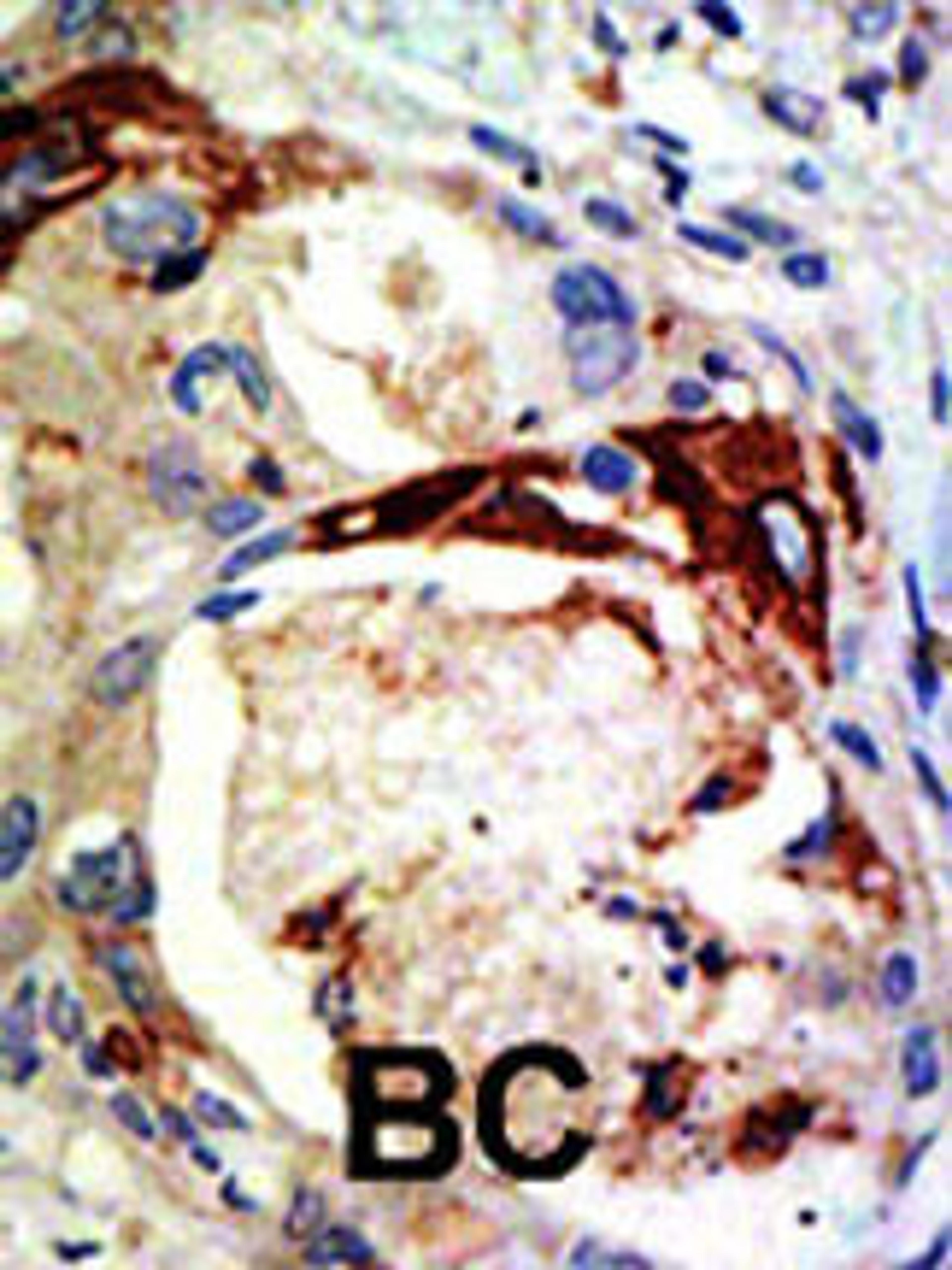 Formalin-fixed and paraffin-embedded human cancer tissue reacted with the primary antibody, which was peroxidase-conjugated to the secondary antibody, followed by DAB staining. BC = breast carcinoma; HC = hepatocarcinoma.