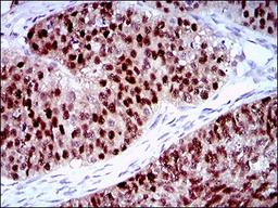 Immunohistochemistry: PLAGL1 Antibody (8D8C5) [NBP2-37343] - Immunohistochemical analysis of paraffin-embedded ovarian cancer tissues using PLAGL1 mouse mAb with DAB staining.