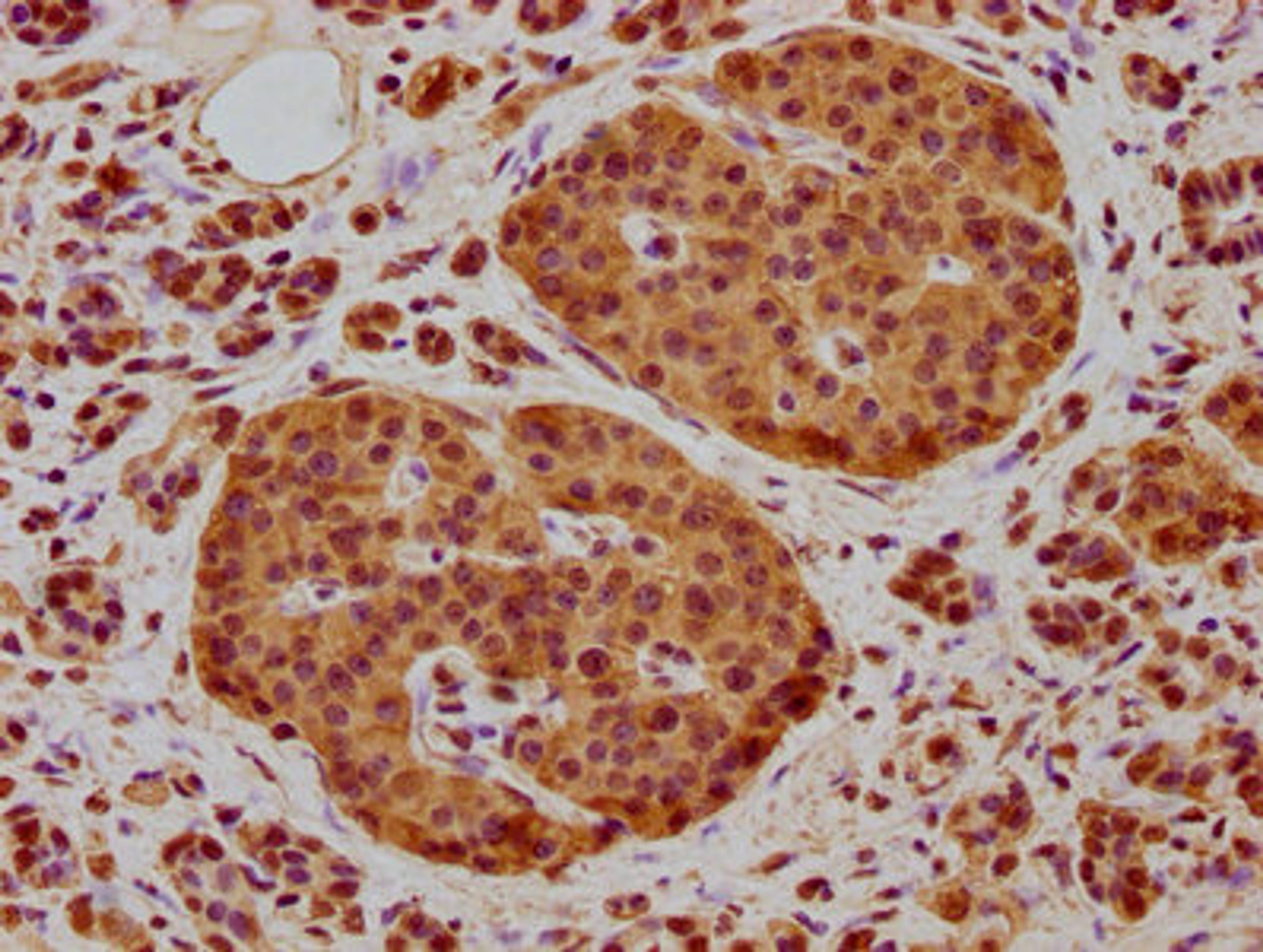 IHC image of CSB-PA015722LA01HU diluted at 1:400 and staining in paraffin-embedded human pancreatic cancer performed on a Leica BondTM system. After dewaxing and hydration, antigen retrieval was mediated by high pressure in a citrate buffer (pH 6.0). Section was blocked with 10% normal goat serum 30min at RT. Then primary antibody (1% BSA) was incubated at 4°C overnight. The primary is detected by a biotinylated secondary antibody and visualized using an HRP conjugated SP system.