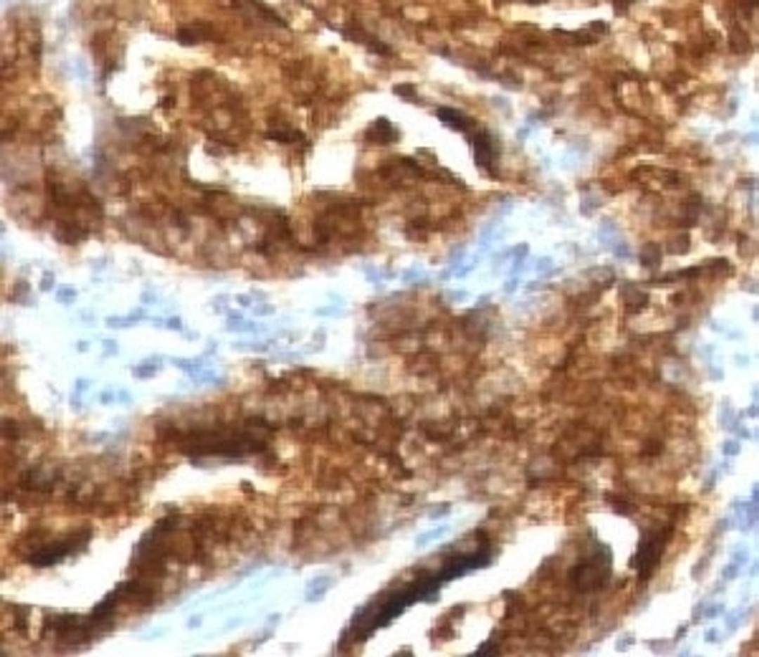 IHC testing of human prostate carcinoma with TAG-72 antibody (CA72/733).