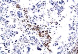 Immunohistochemical analysis of paraffin-embedded human lung cancer tissue using CXCR4 antibody.