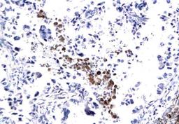 Immunohistochemical analysis of paraffin-embedded human lung cancer tissue using CXCR4 antibody.