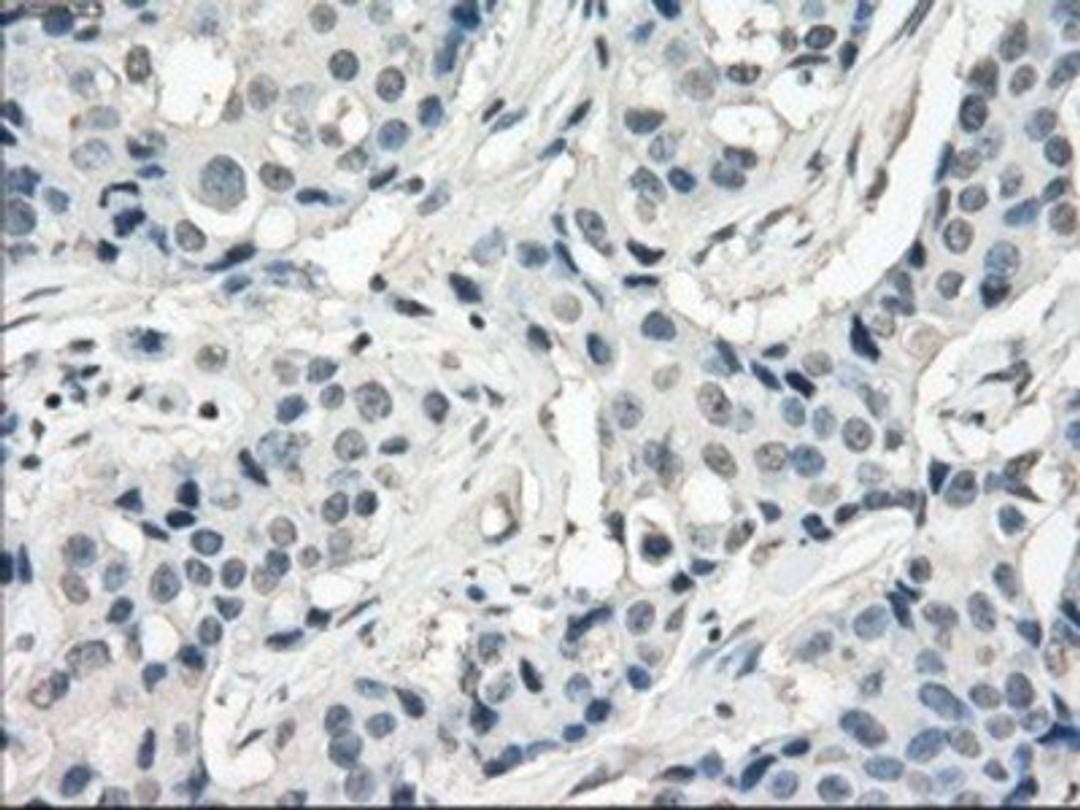 Immunohistochemistry-Paraffin: FOSL1 Antibody (12F9) [NBP1-47757] - Staining of paraffin-embedded Adenocarcinoma of breast tissue using anti-FOSL1 mouse monoclonal antibody.