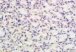 Immunohistochemical analysis of paraffin-embedded human stomach adenocarcinoma using CD40 antibody.